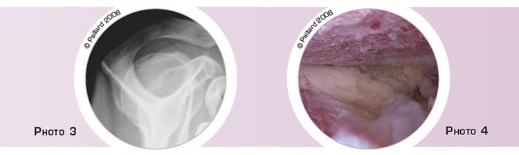 Acromioplastie de l’épaule à Paris par docteur Paillard, Chirurgien orthopédique