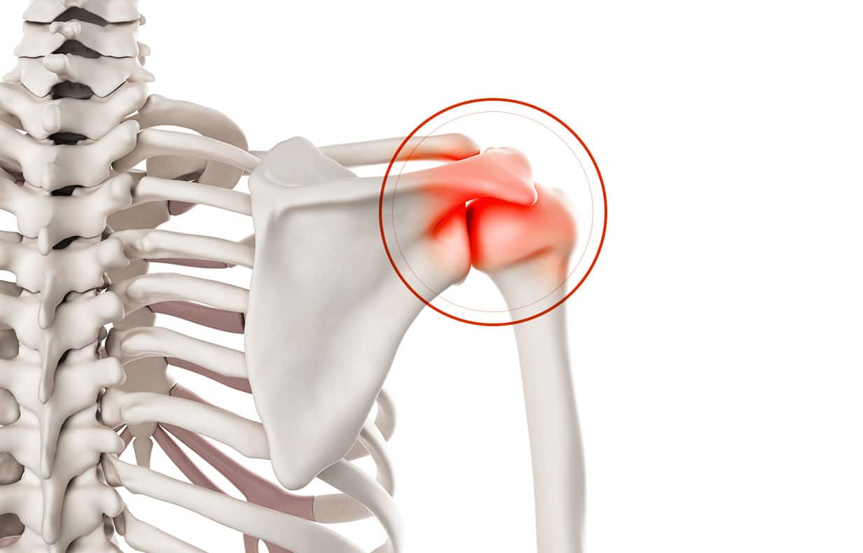 Chirurgie de l’épaule à Paris: Arthrolyse de l’épaule - Dr Paillard, Chirurgien orthopédique à Paris