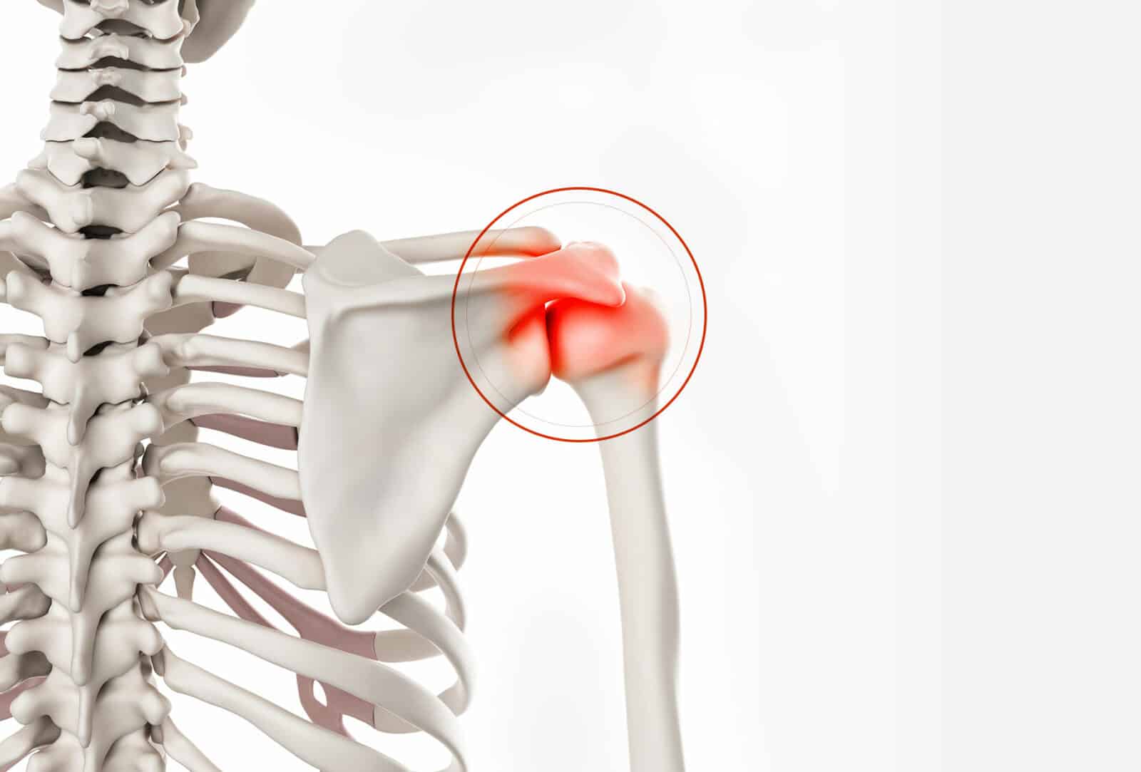 Chirurgie de l’épaule (Acromioplastie de l’épaule) à Paris - Docteur Paillard: Chirurgien orthopédique