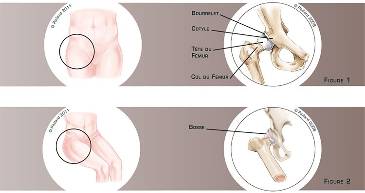Définition d'un conflit de hanche (Arthrolyse de hanche) par docteur Paillard: Chirurgien orthopédique