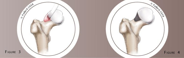 Qu’est ce qu’une arthrolyse de hanche? Définition par dr Paillard: Chirurgien orthopédique à Paris