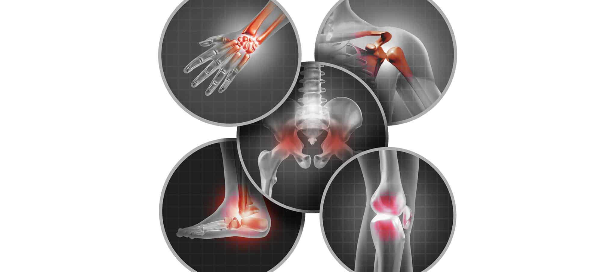 Arthrose (usure des cartilages): Causes - Symptômes et Traitement à Paris - dr Paillard