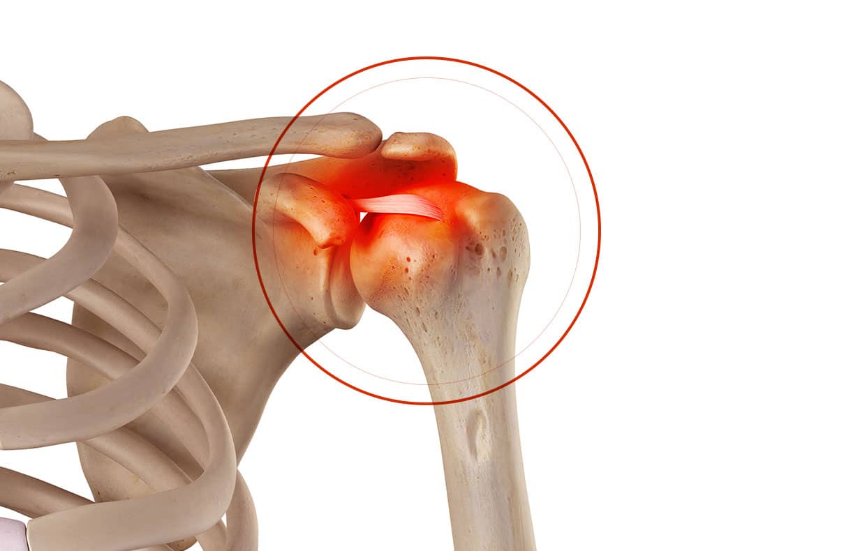 Chirurgie de l’épaule à Paris: Calcification des tendons de l’épaule - Dr Paillard
