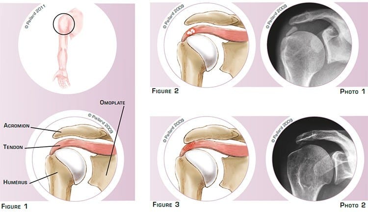 Qu’est ce qu’une calcification des tendons de l’épaule? Définition par dr Paillard