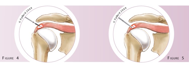 Qu’est ce qu’une évacuation arthroscopique d’une calcification de l’épaule? Définition par dr Paillard