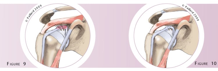 Chirurgie du biceps au niveau de l’épaule à Paris par Dr Paillard