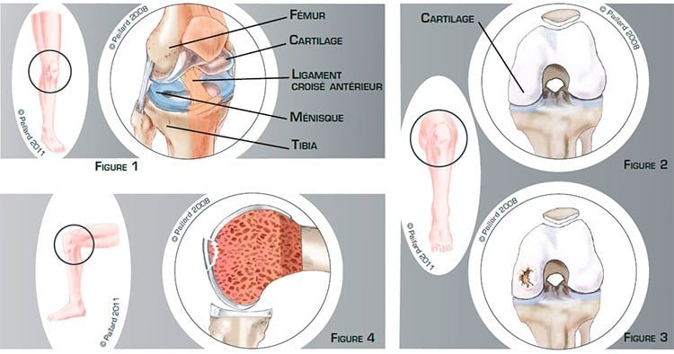 L'arthrose du genou - Institut de Chirurgie Réparatrice Locomoteur & Sport