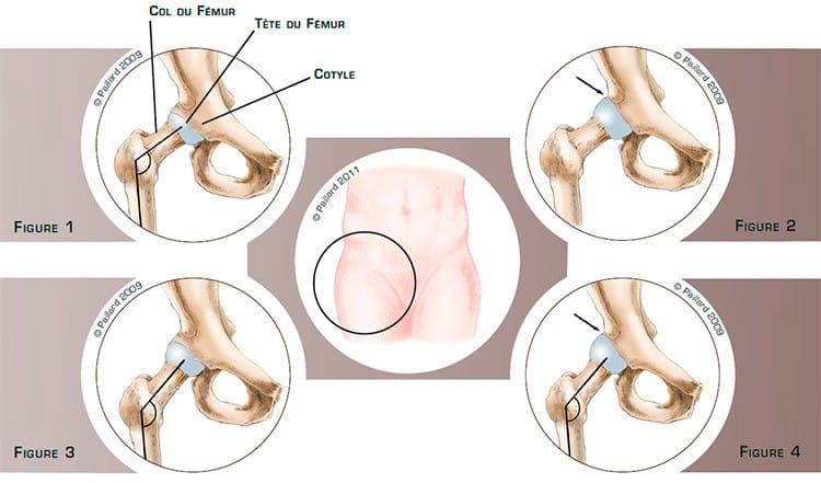 Qu’est ce qu’une dysplasie de la hanche? Définition par dr Paillard