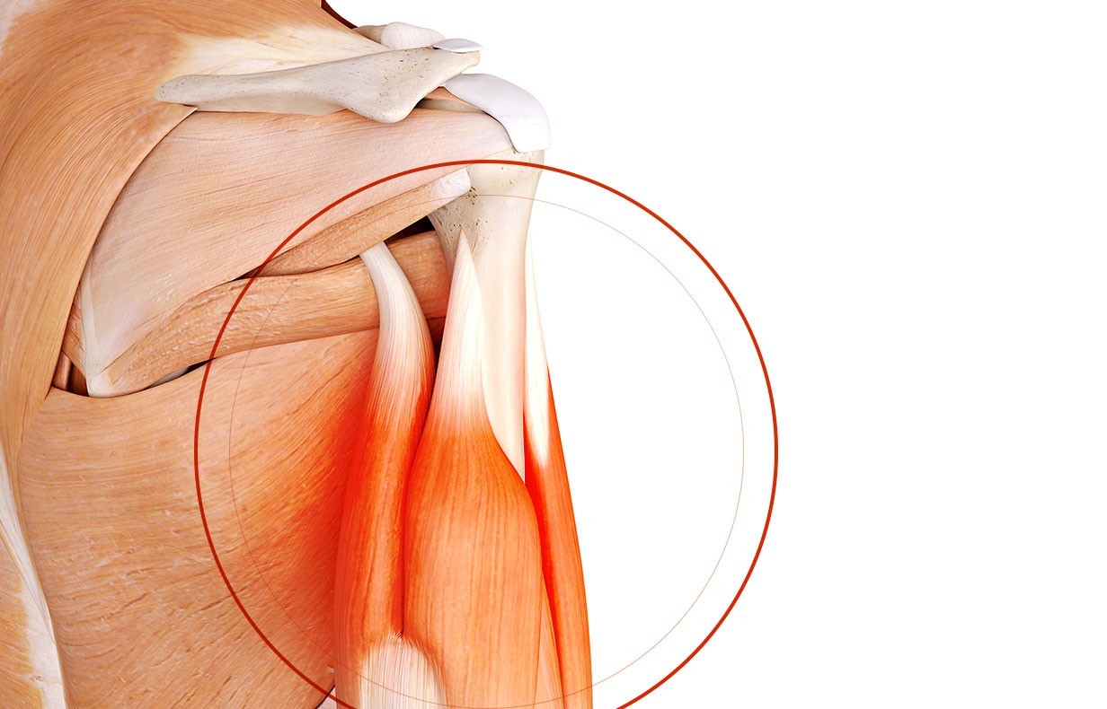 Chirurgie de l’épaule à Paris: Chirurgie du biceps - Dr Paillard, Chirurgien orthopédique