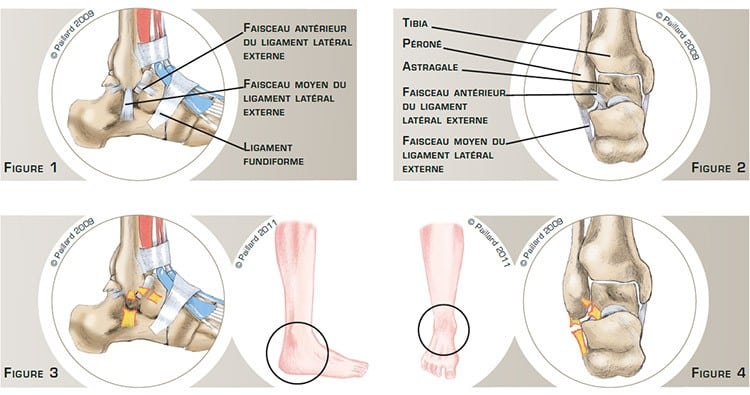 Chirurgie de la cheville à Paris: Instabilité de la cheville - dr Paillard