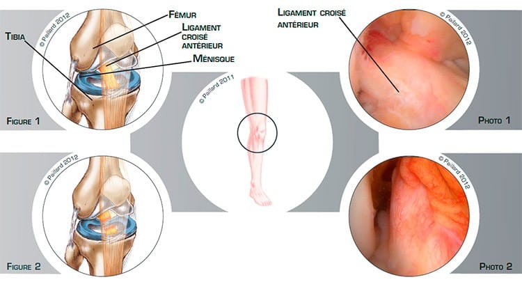 Qu’est ce qu’une rupture du ligament croisé antérieur? Définition par dr Paillard