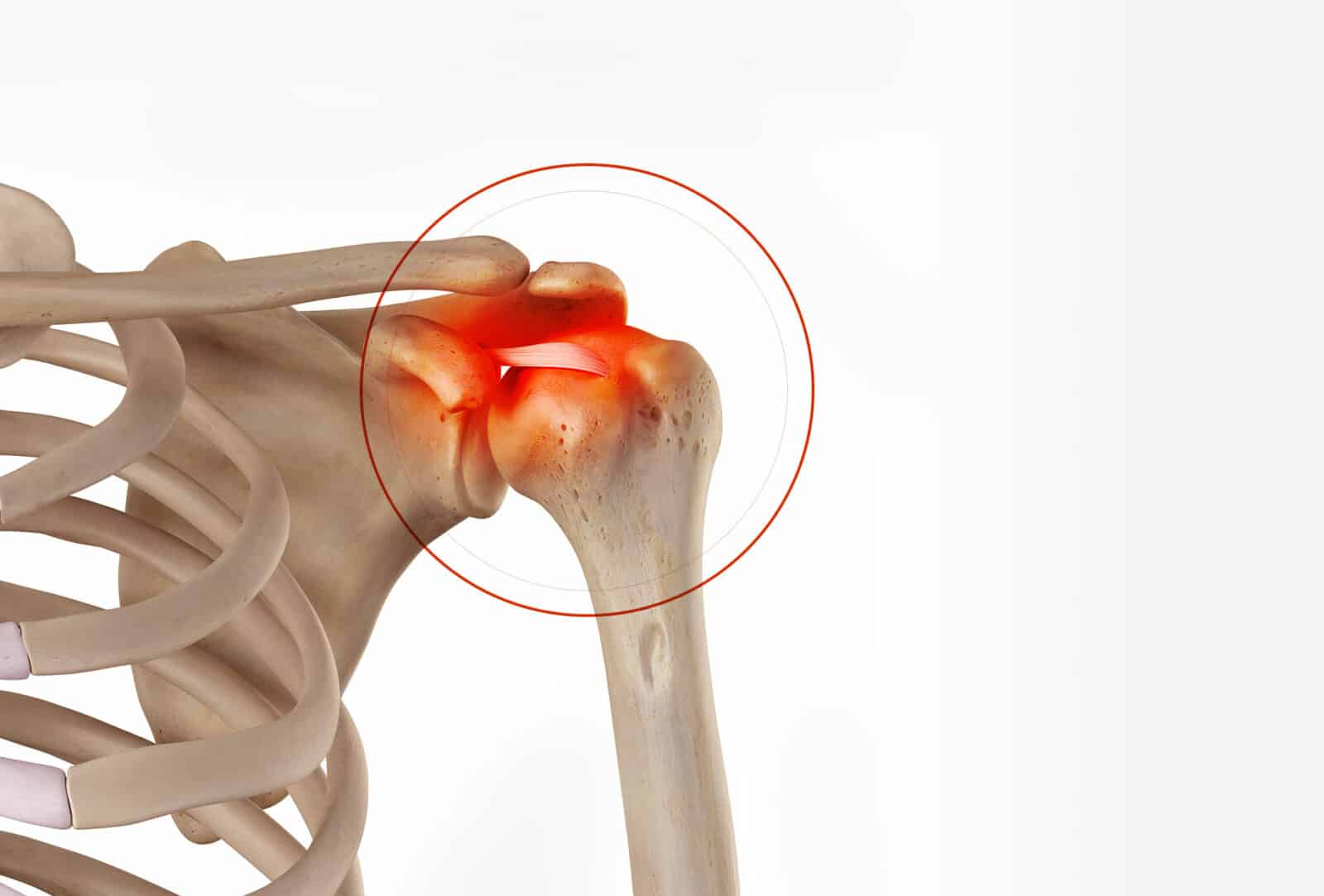 Symptomes Et Diagnostic De La Luxation Acromi Claviculaire Dr Paillard