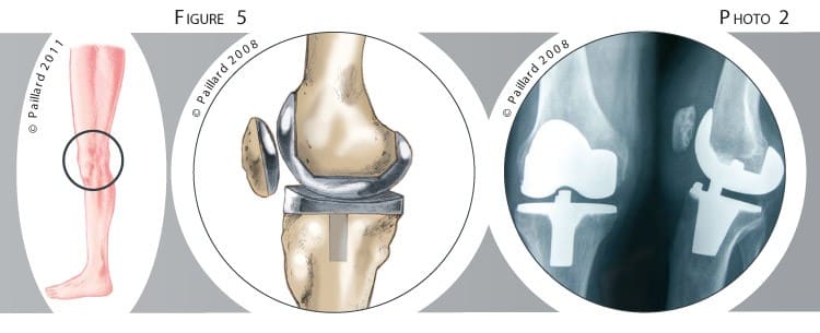 Traitement de l'arthrose du genou par prothèse totale à Paris - Dr Paillard