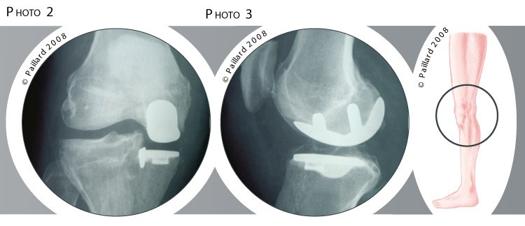 Traitement de la rupture du ligament croisé antérieur à Paris - Dr Paillard