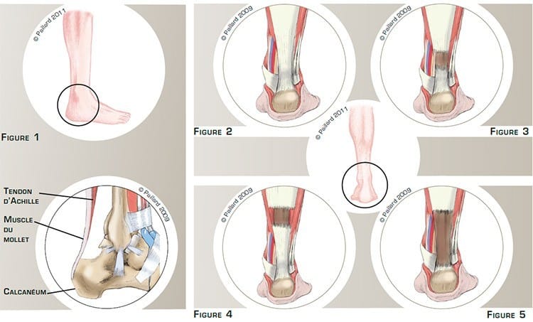 Réparation du tendon d'Achille à Paris - Chirurgie orthopédique ...