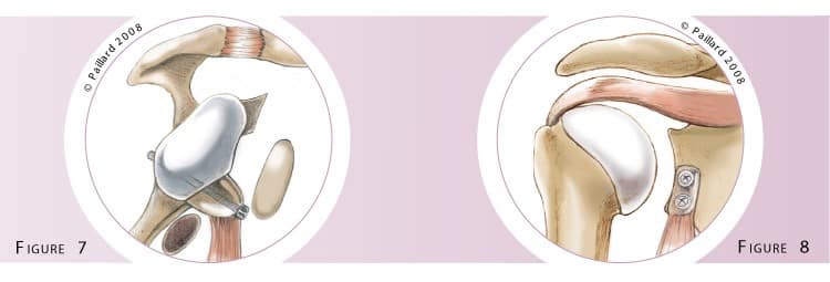 Traitement d'une épaule instable à Paris - Dr Paillard: Chirurgien orthopédique