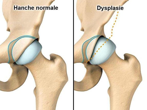Définition, symptômes et diagnostic de la dysplasie de hanche | Dr ...