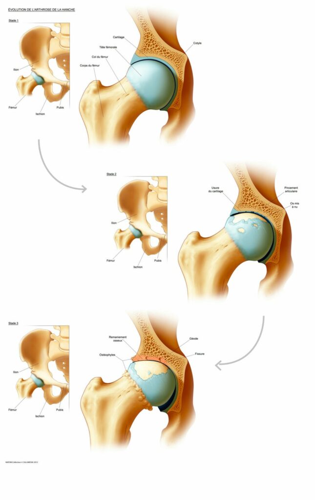 L'arthrose : Causes, Symptômes, Prévention et Traitement de l'arthrose