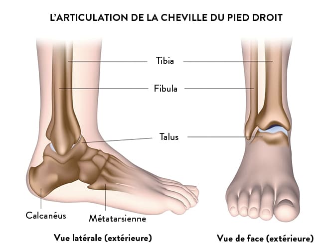 Arthrose de cheville : traitement et opération