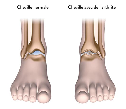 Définition, symptômes et diagnostic de l'arthrose de cheville | Dr ...