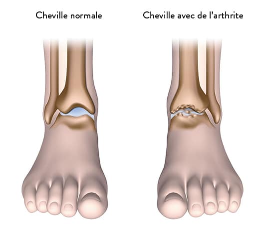 Entorse de la cheville : combien de temps sans marcher ?