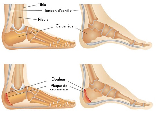 Peignage du tendon d'Achille à Paris - Chirurgie orthopédique | Dr ...