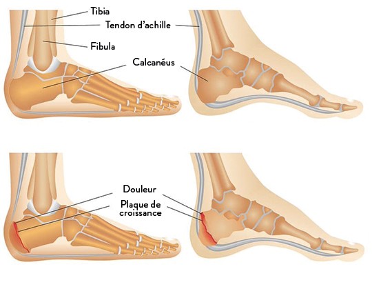 Trois semaines de plâtre suffisantes pour soigner une fracture ? 