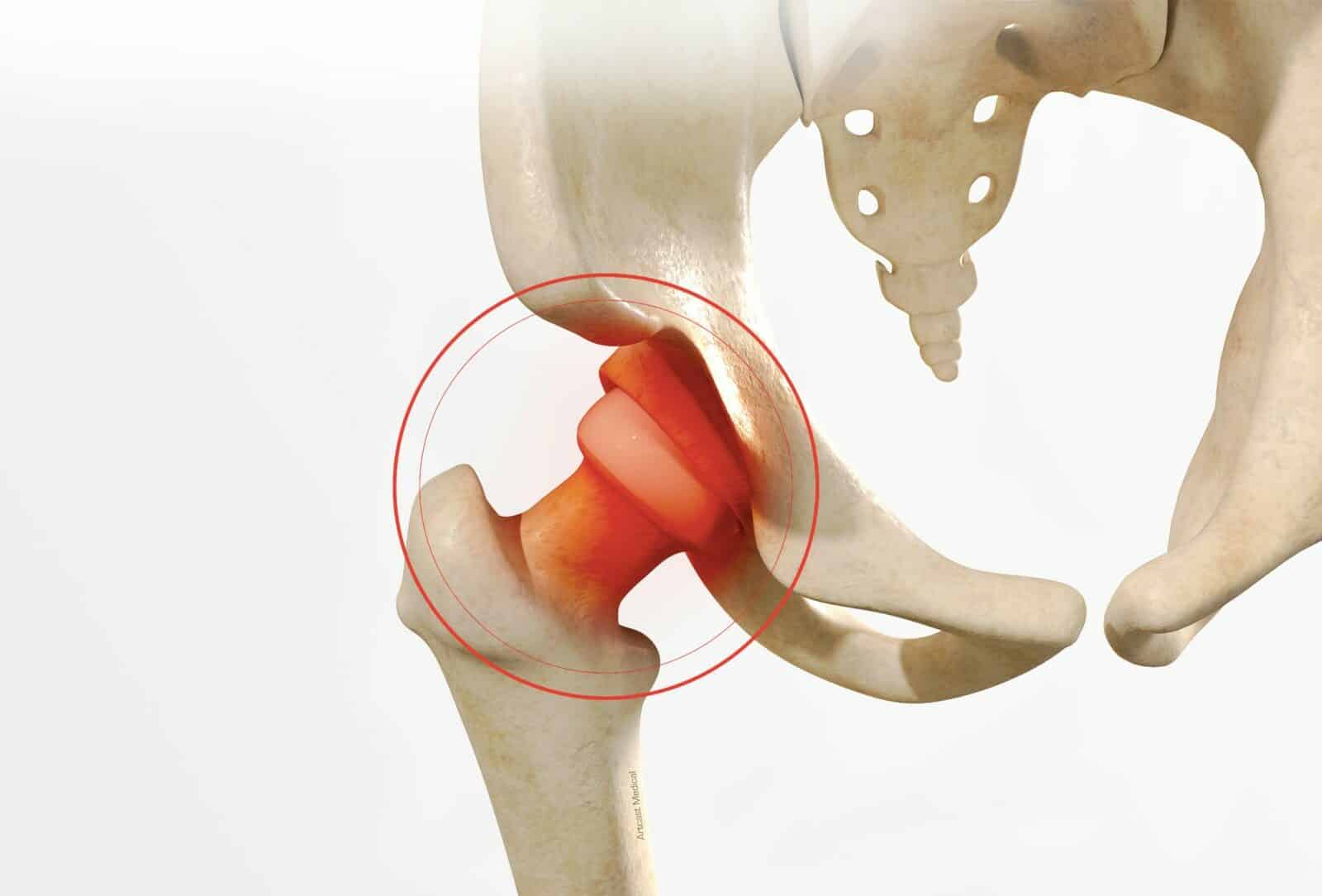 Traitement de l'Arthrolyse de hanche à Paris - dr Paillard, Chirurgien orthopédique