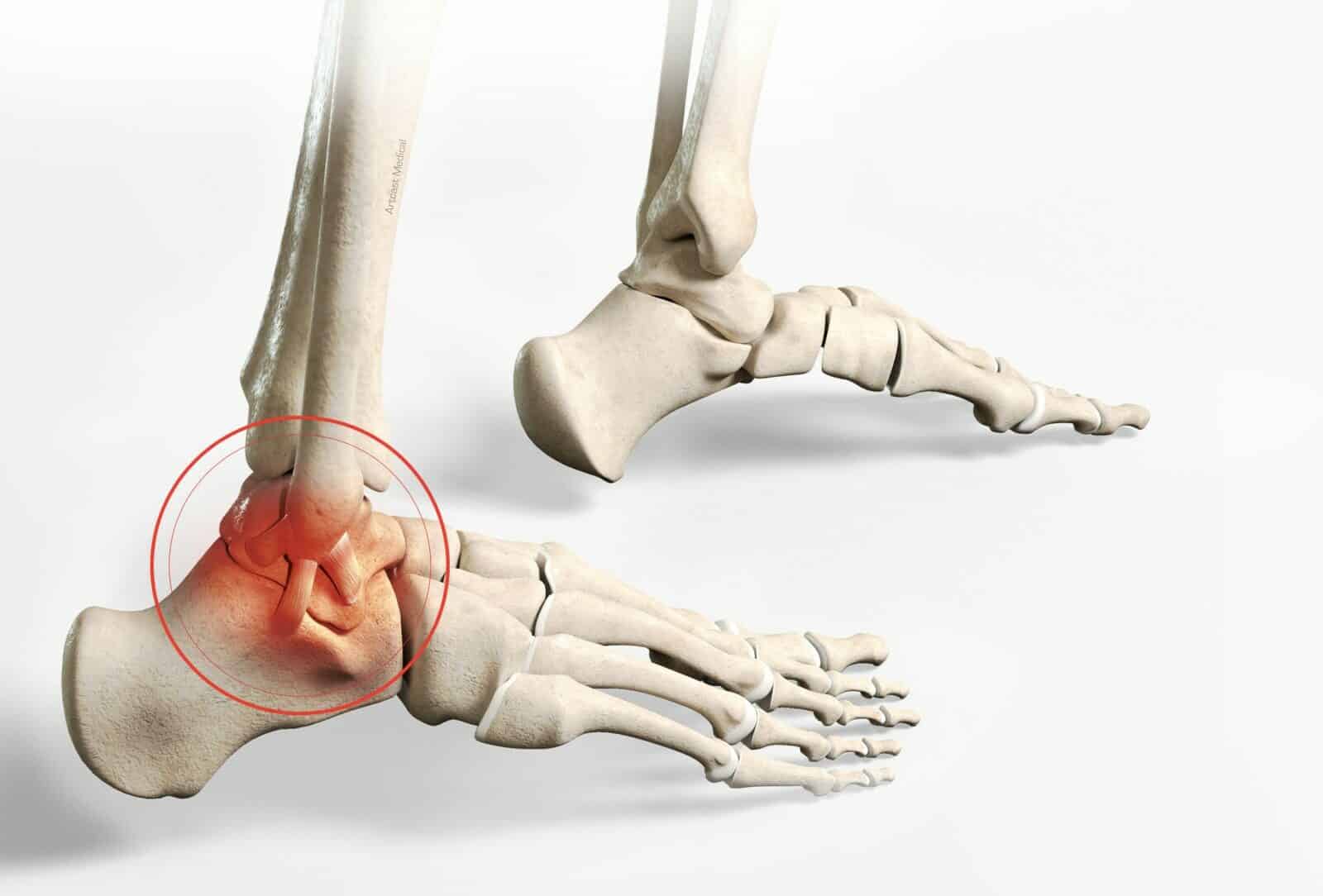 Arthroscopie de la cheville - Chirurgie par dr Paillard à Paris