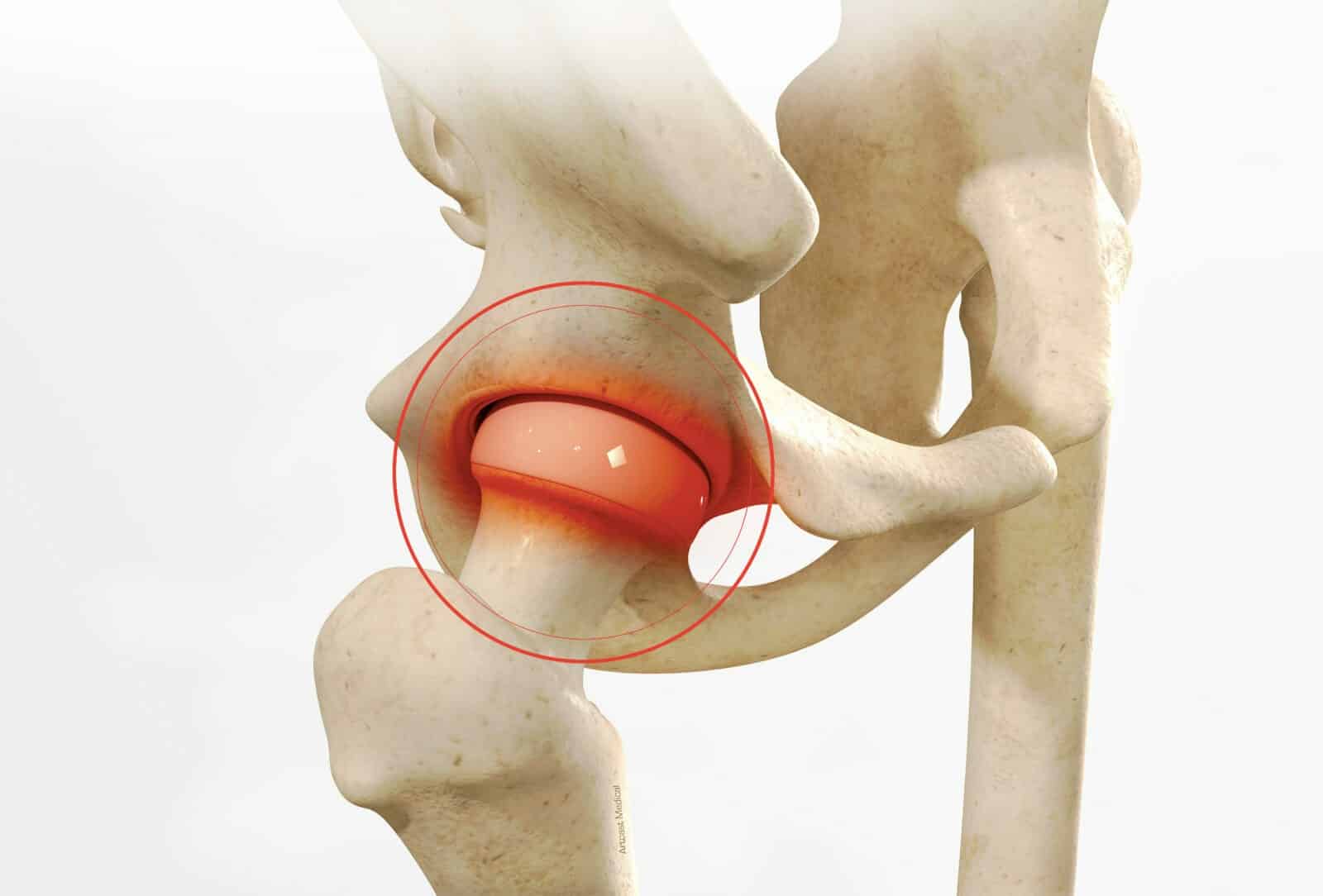 Arthroscopie de la hanche : Chirurgie par dr Paillard à Paris