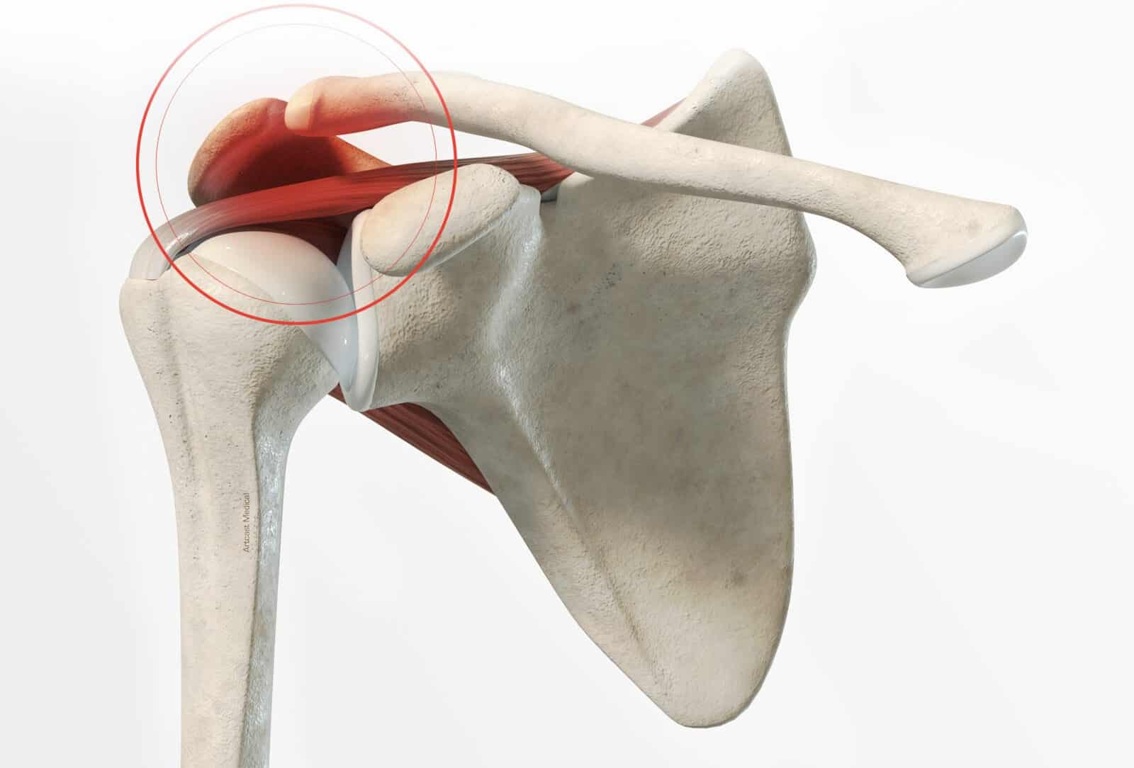 Symptômes et diagnostic de l'arthrose claviculaire | Dr Paillard