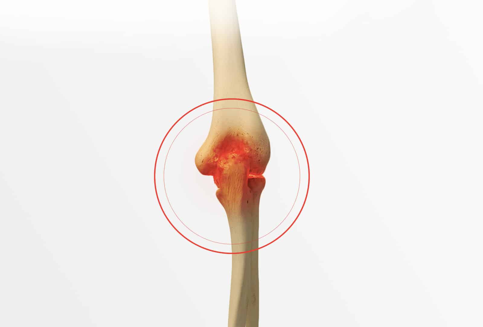 Arthrose du coude: symptômes et traitement à Paris - Dr Paillard