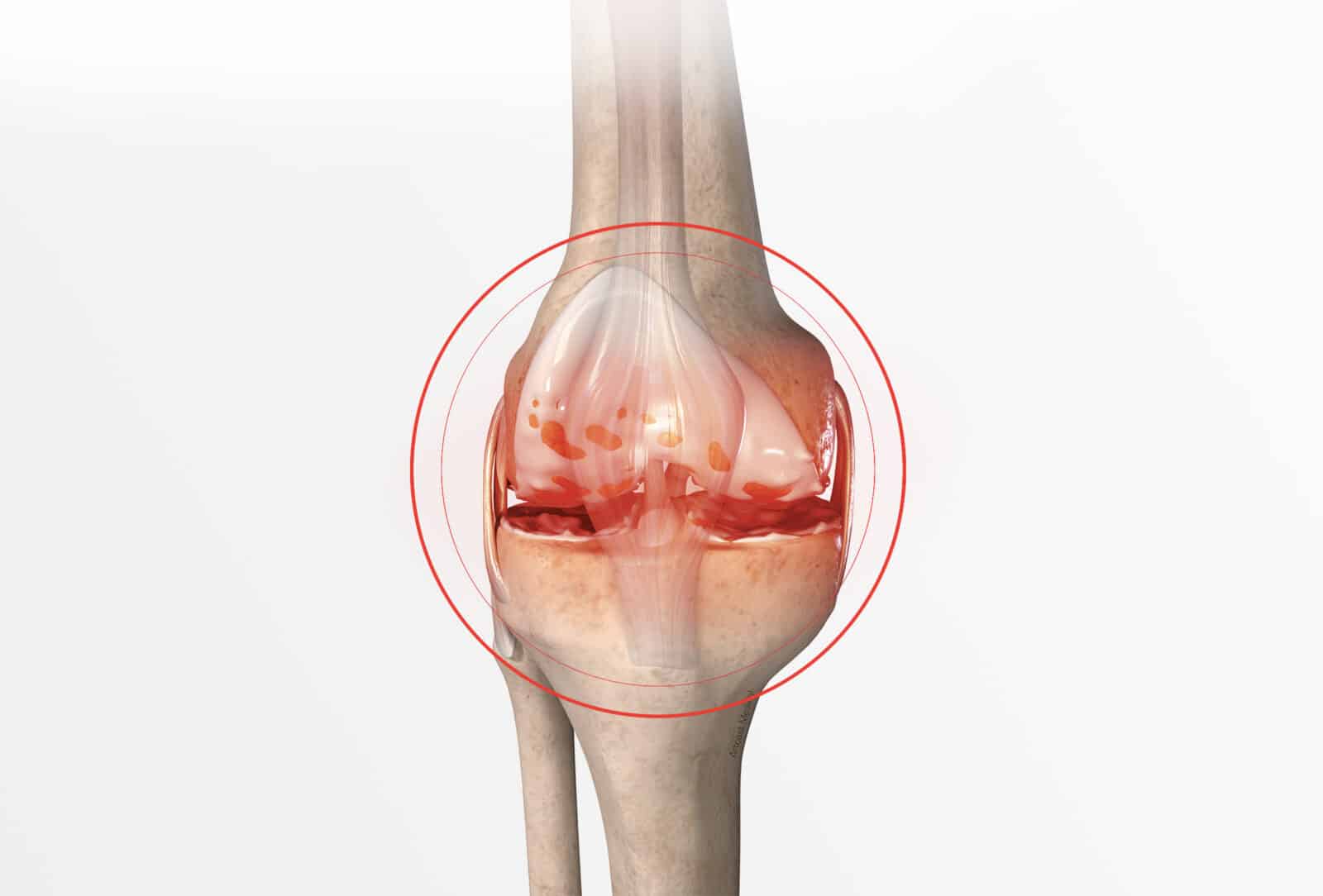 Gonarthrose (Arthrose du genou): symptômes et diagnostic à Paris - Dr Paillard