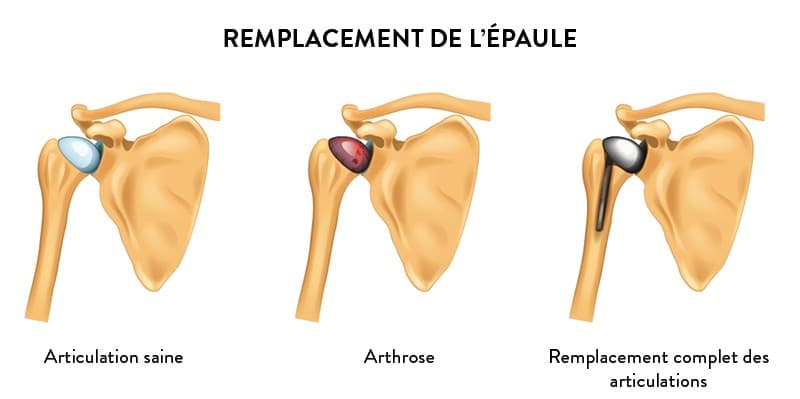 Définition, symptômes et diagnostic de l'arthrose de l'épaule