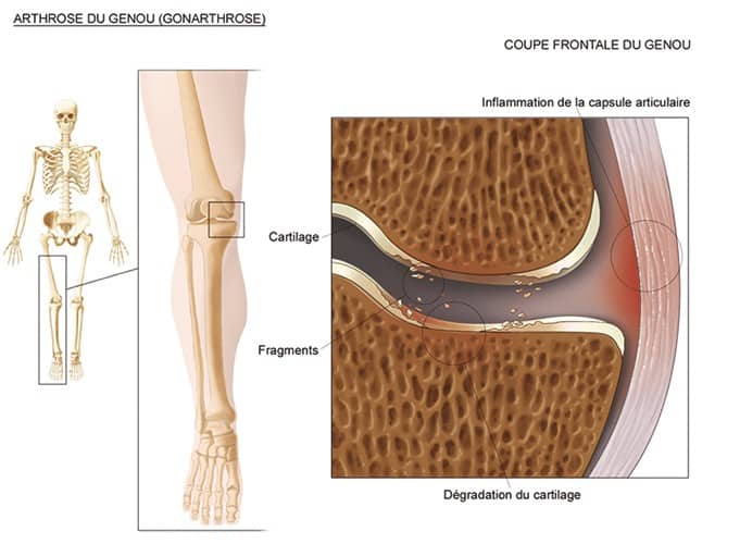 Arthrose du genou - Douleur d'arthrose au genou