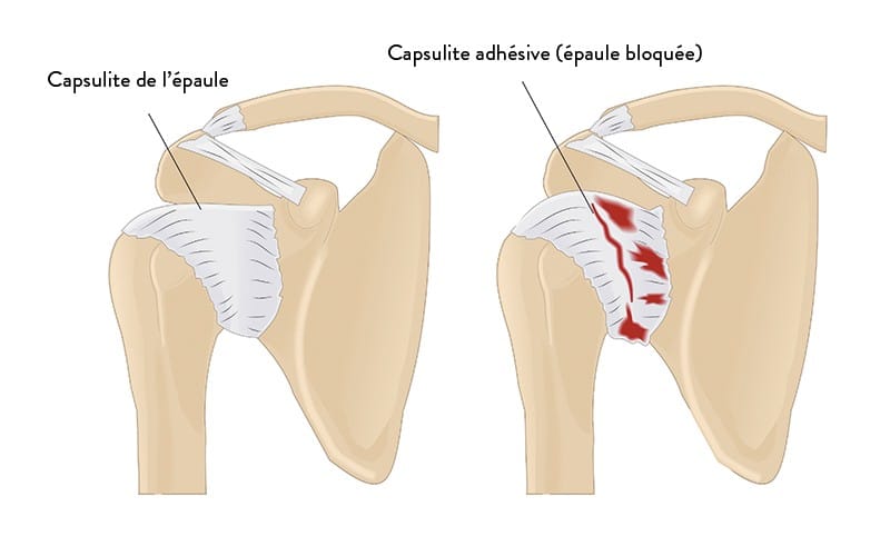 Définition, symptômes et diagnostic de la capsulite de épaule | Dr ...