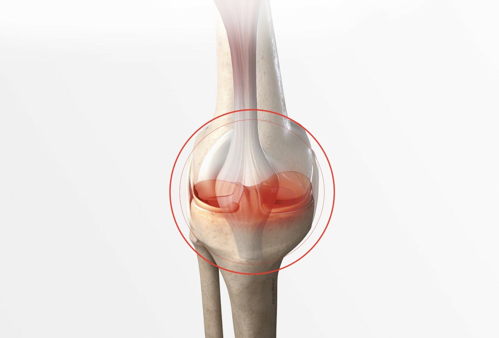 Chirurgie du genou à Paris: Chirurgie méniscale - Dr Paillard