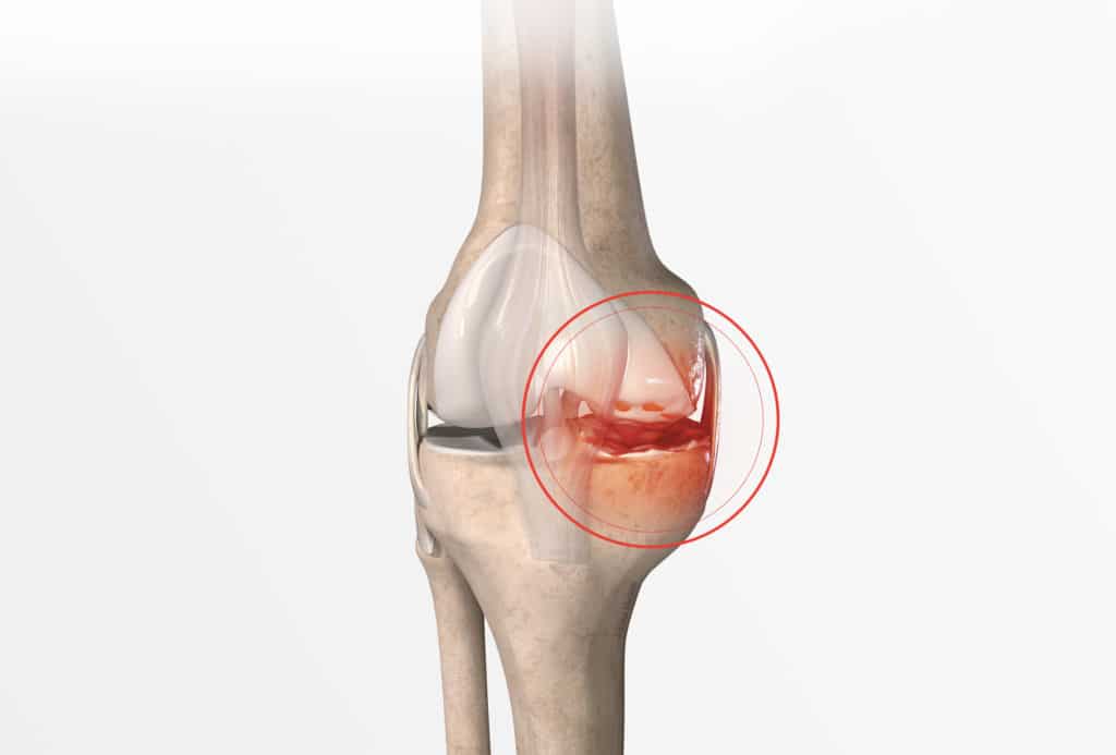 Définition, symptômes et diagnostic de la chondropathie Dr Paillard — free download
