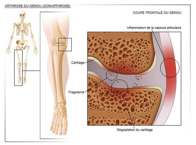 Arthrolyse antérieur de la cheville à Paris