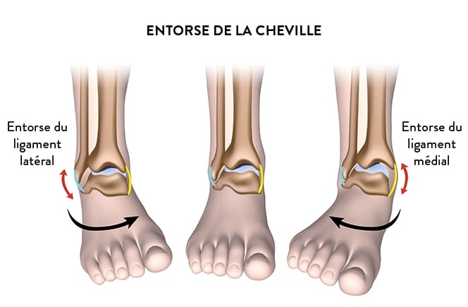 Définition, symptômes et diagnostic de l'entorse de cheville