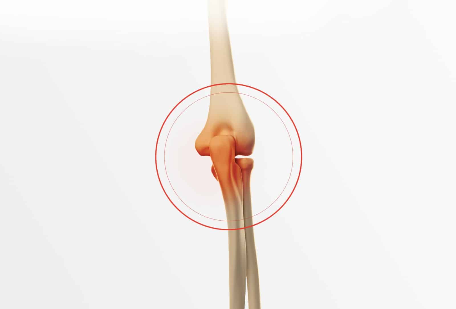 Traitement fracture du coude à Paris - Dr Paillard: Chirurgien orthopédique