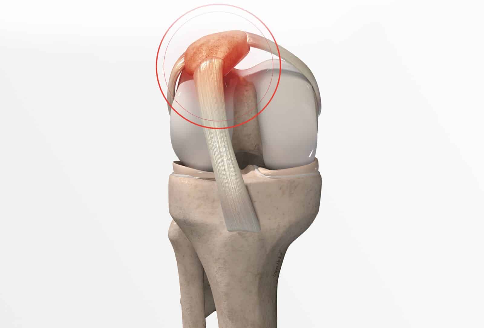 Traitement de l'nstabilité rotulienne à Paris - Dr Paillard: Chirurgien orthopédique