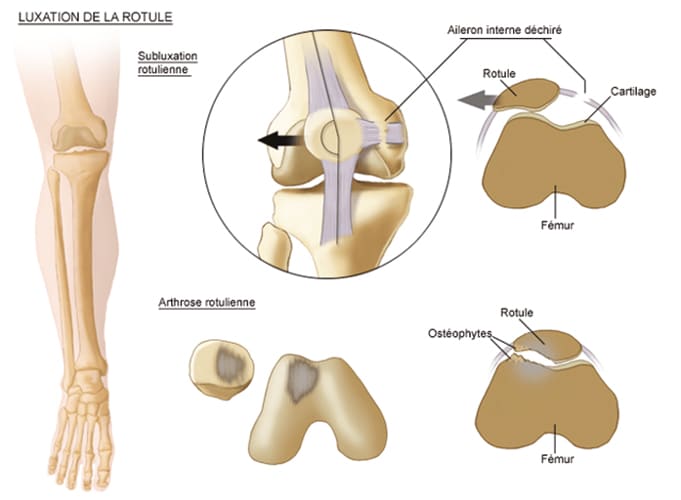 Symptômes et diagnostic de la tendinite du talon rotulien