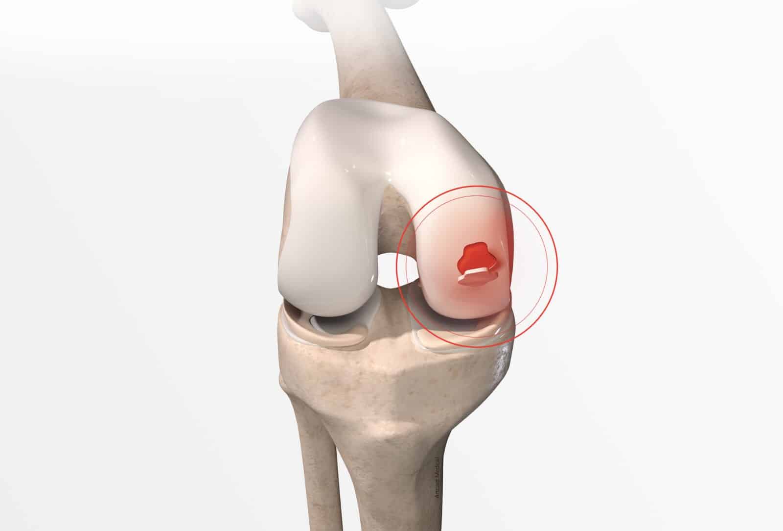 Traitement de la lésion du cartilage du genou (cartilage genou abimé) à Paris - Dr Paillard