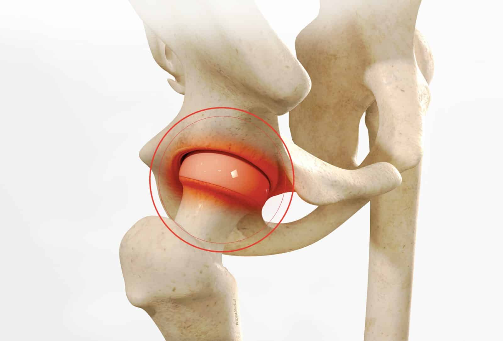 Symptomes Et Diagnostic De La Lesion Du Bourrelet Cotyloidien Dr Paillard