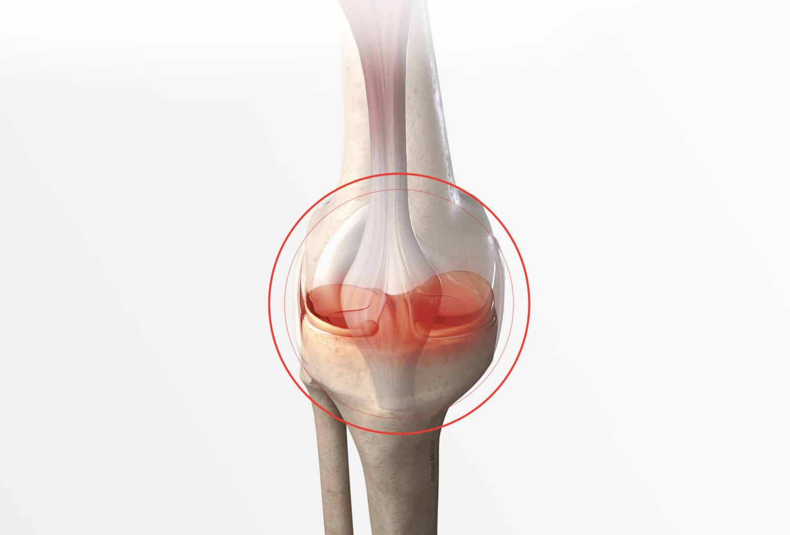 Pathologies des genoux: Lésion méniscale (symptômes et diagnostic) à Paris