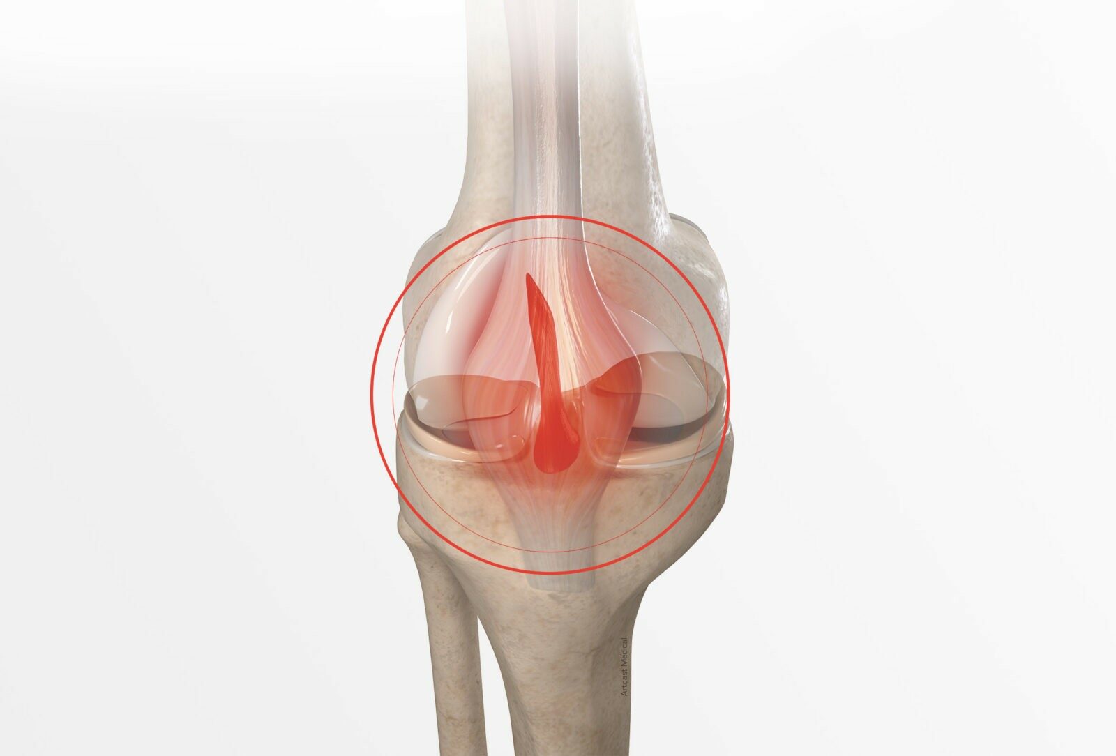 Chirurgie du genou à Paris: Ligamentoplastie du genou - Dr Paillard