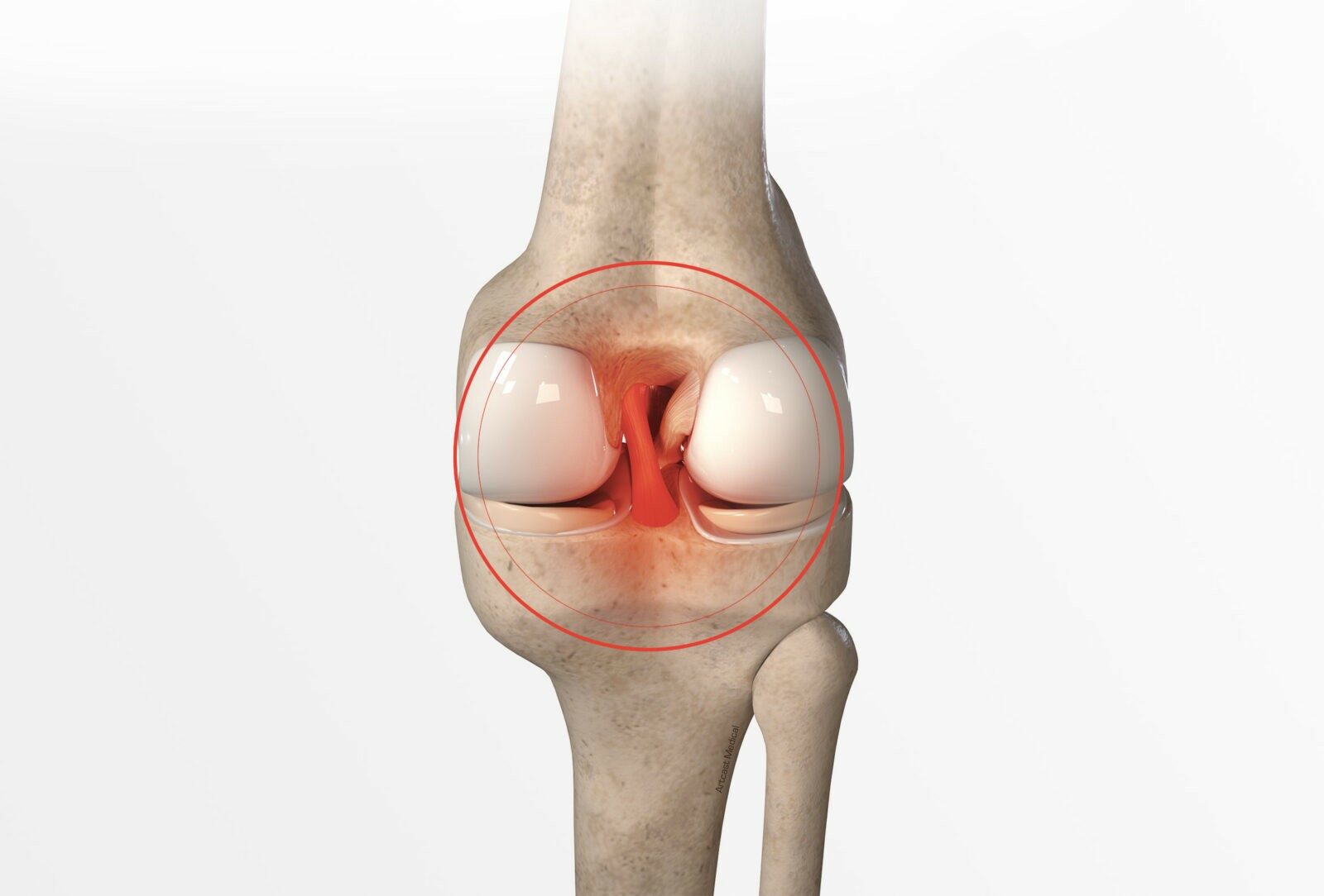 Chirurgie du genou à Paris: Ligamentoplastie du croisé postérieur - Dr Paillard
