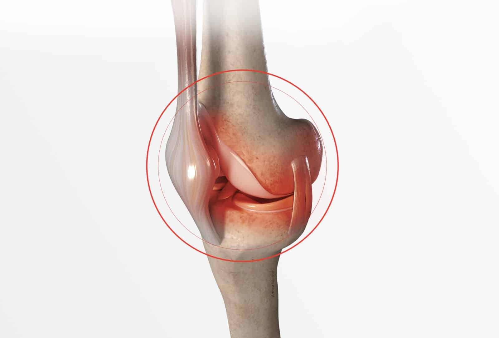 Définition, symptômes et diagnostic de la luxation du genou