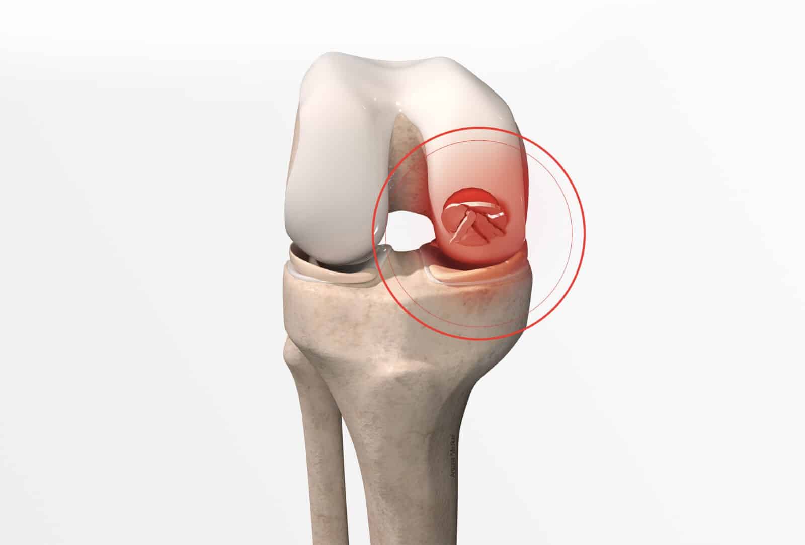 Traitement de l'ostéochondrite du genou à Paris - Dr Paillard